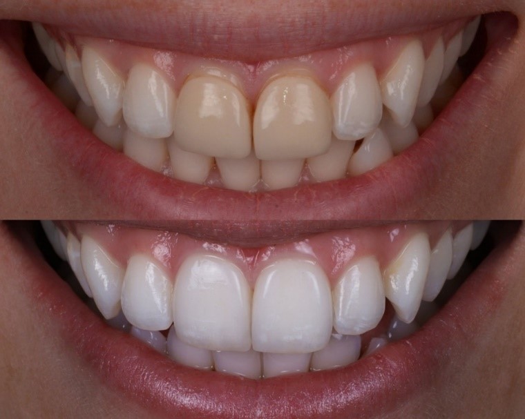 Dental veneers example