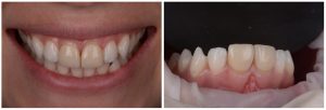 Veneers Case