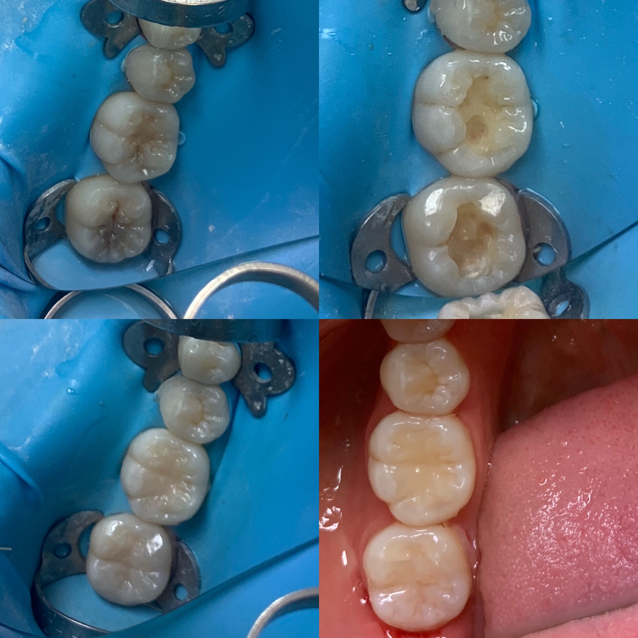 White Filling by Ilan