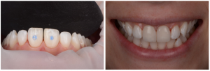 Images VENEERS