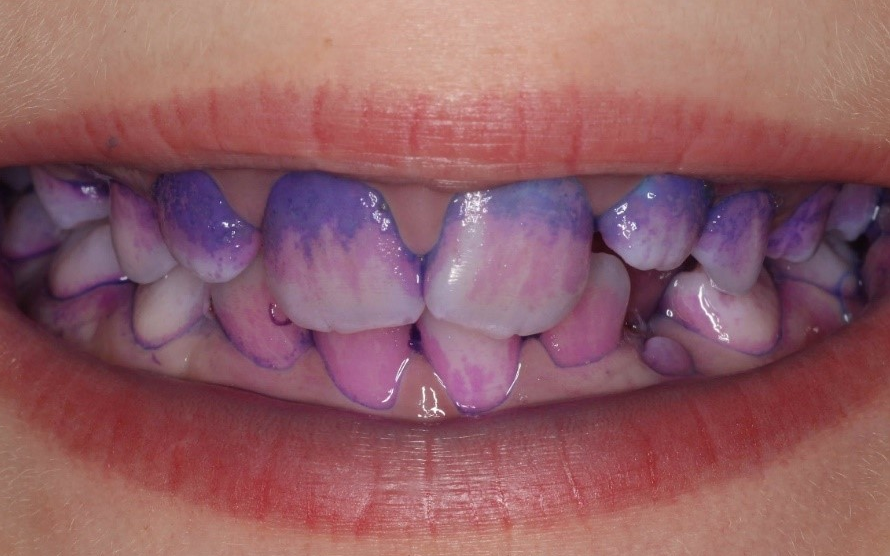 Plaque on patients tooth