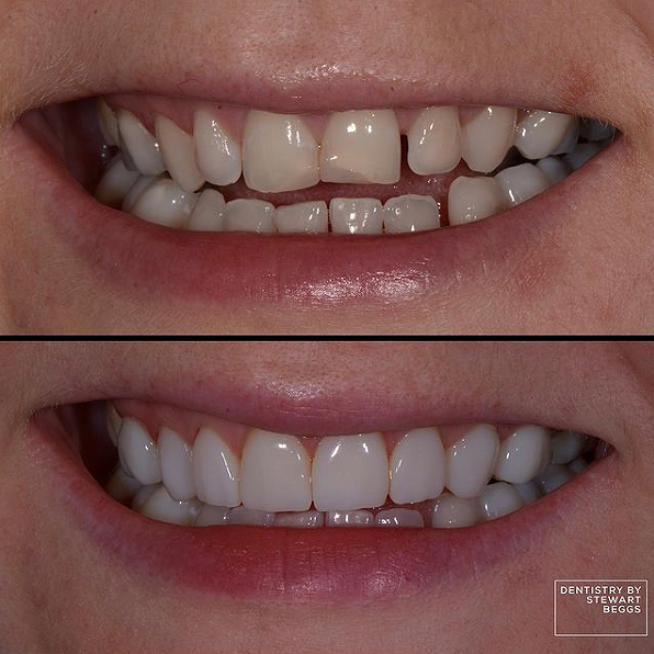 Dental veneers example