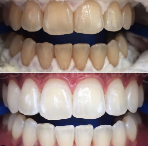 Zoom whitening