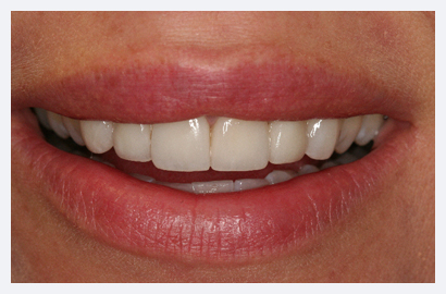 Veneers
