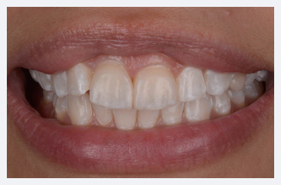 Whitening, Composite Bonding and Veneers