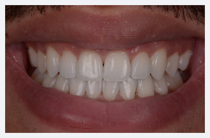 Invisalign, Whitening and Composite Bonding