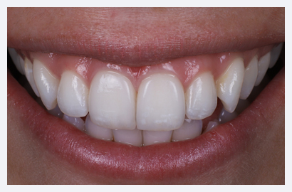 Veneers and Home Whitening