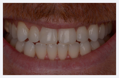 Invisalign & Whitening