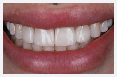 Invisalign & Composite Bonding