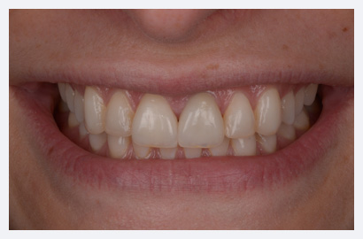 Whitening and Veneers