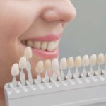 Teeth Whitening in London - Bow Lane Dental Group