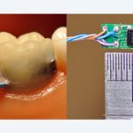 Sensors in the teeth