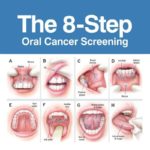 Mouth Cancer Symptoms - Bow lane Dental Group