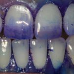 Plaque Disclosing Tablets