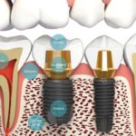 Dental Implants in London