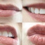 Teeth Cleaning London