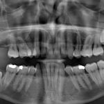 Teeth Extraction - Bow lane dental group