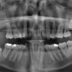 How Safe is Dental X-rays - Bow lane Dental Group