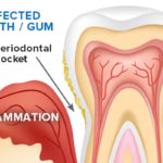 Gum disease - Bow lane Dental Group