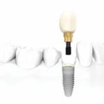 Dental Implants in London - Bow lane Dental Group