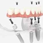 All-on-4 -Bow lane Dental Group