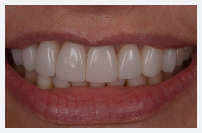 Invisalign and Veneers