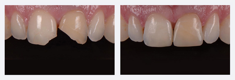 Dental bonding example Dental bonding example
