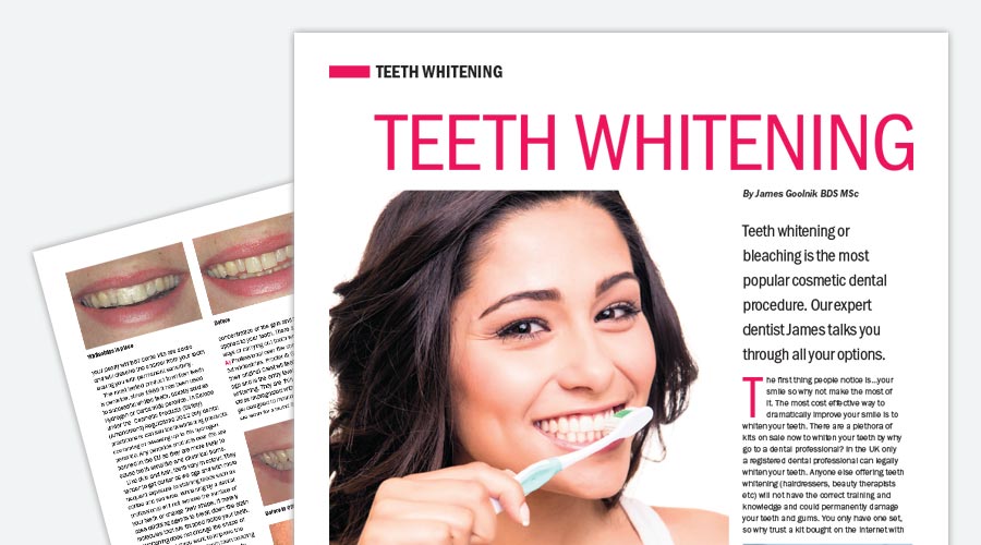 Teeth whitening guide