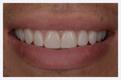 Veneers