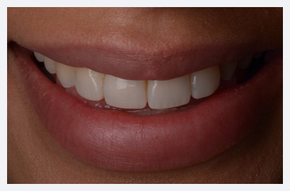 Invisalign and Composite Bonding