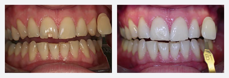 Teeth whitening london Teeth whitening london
