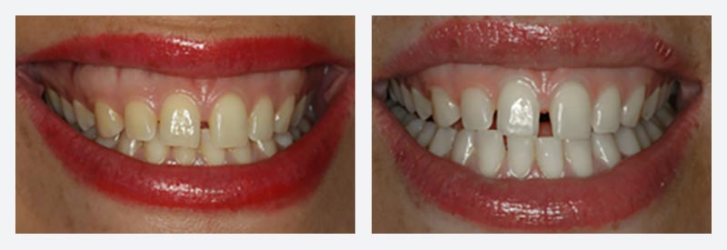 Oral-B Whitestrips teeth whitening example Oral-B Whitestrips teeth whitening example