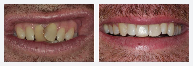 Teeth straightening example