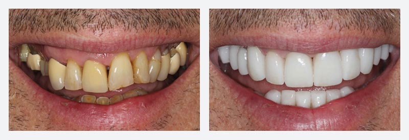 Smile makeover example Smile makeover example