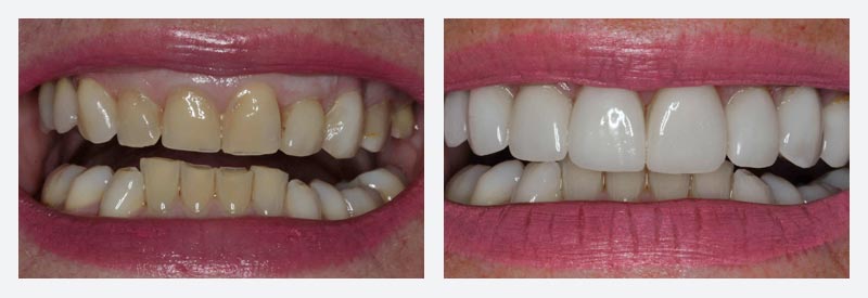 Dental crowns example Dental crowns example