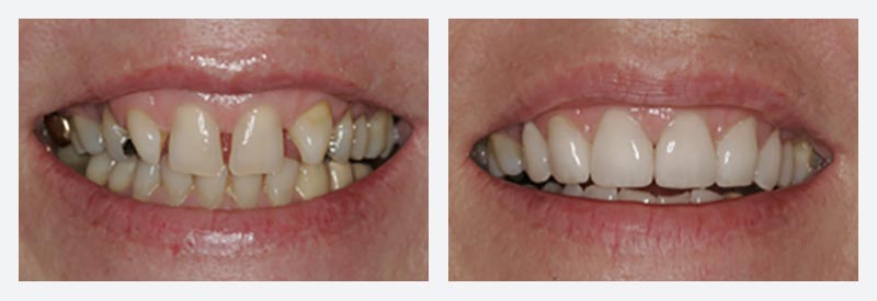 Smile makeover example Smile makeover example