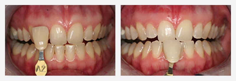 Teeth whitening London Teeth whitening