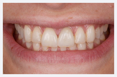 Veneers