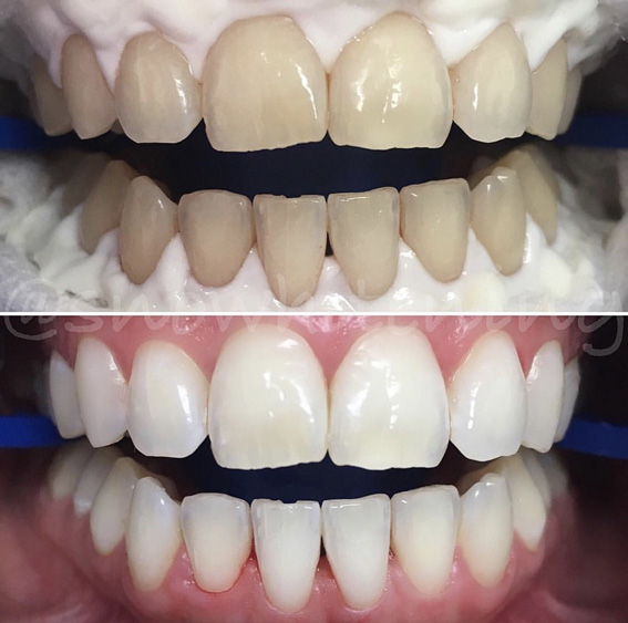 Zoom teeth whitening byRenate